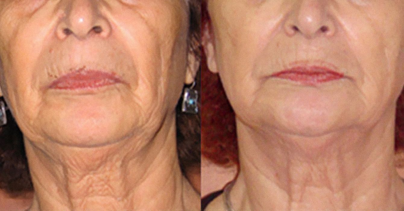 Rostro y cuello de una mujer antes y después de la radiofrecuencia 3DEEP: menos arrugas y piel más firme