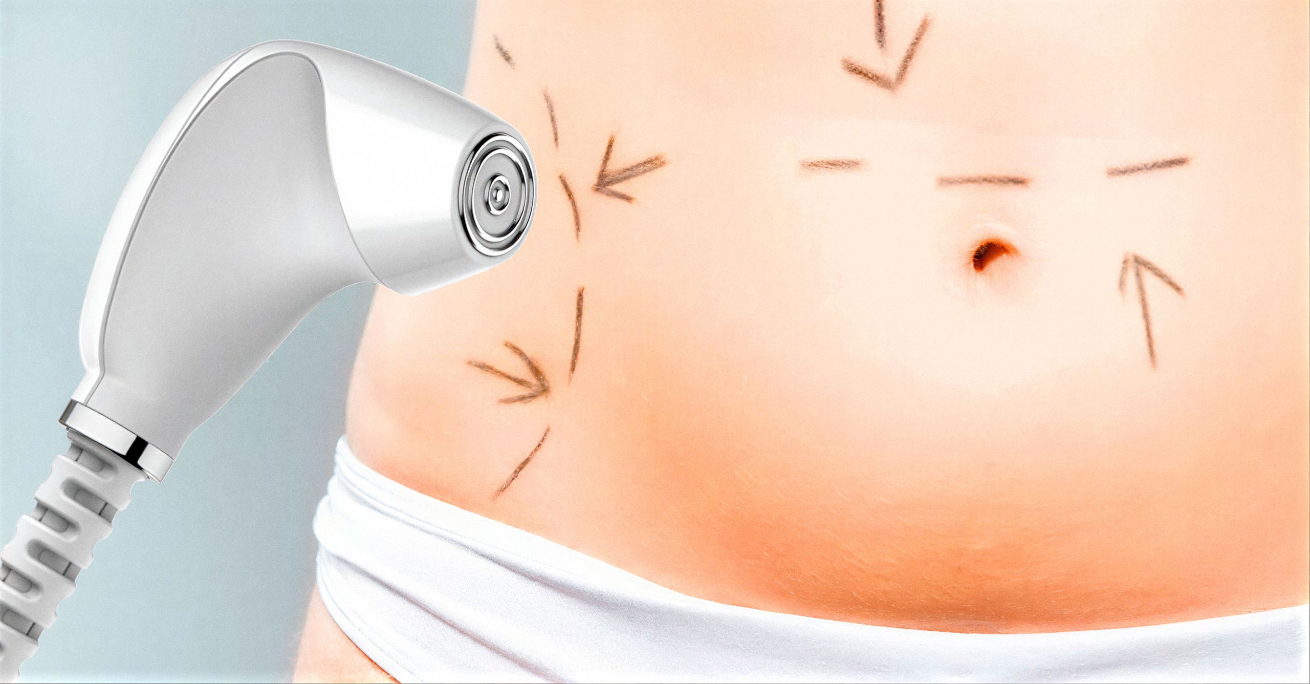 Radiofrecuencia en el abdomen después del parto