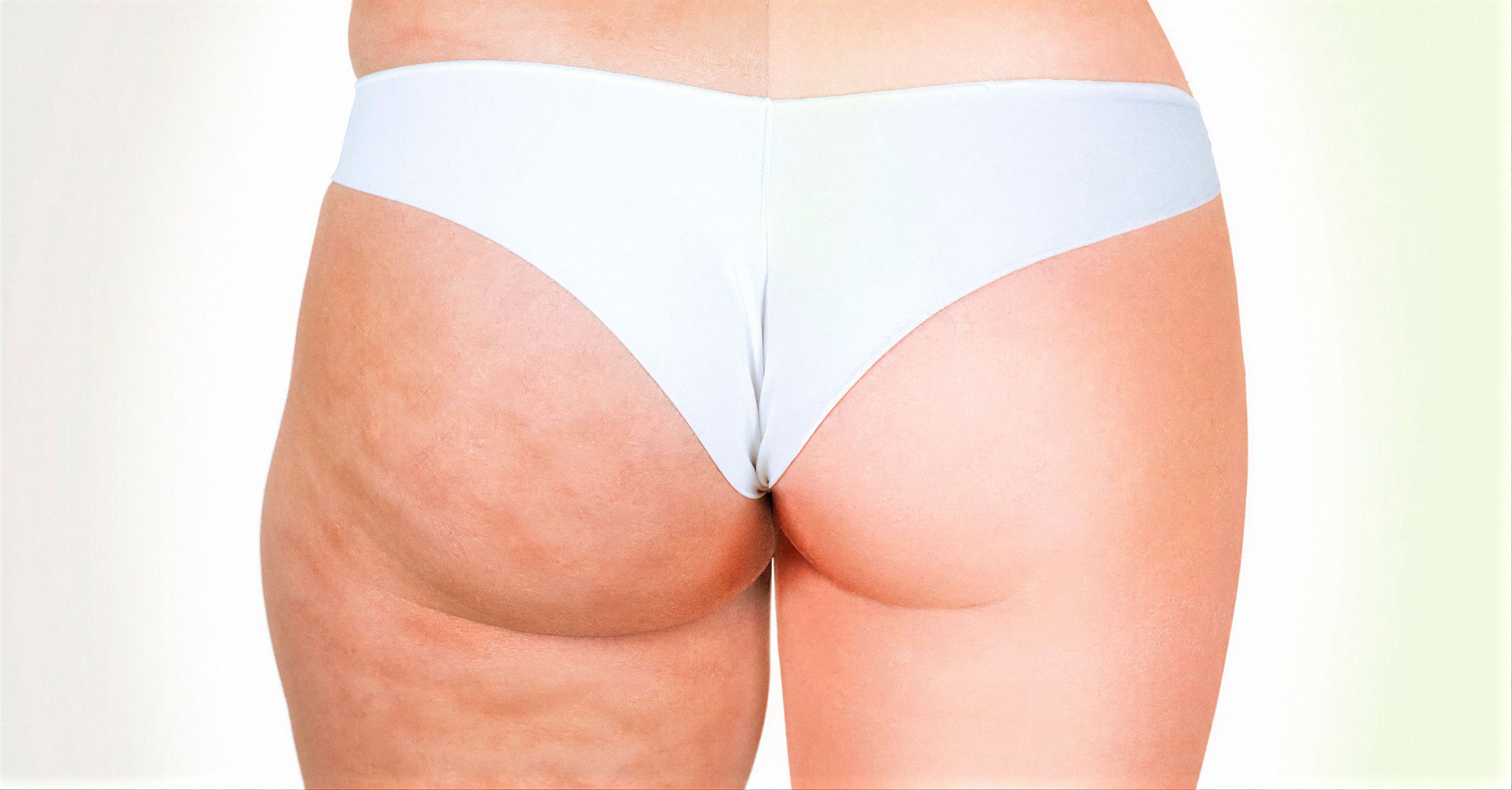 Glúteos y cartucheras con celulitis